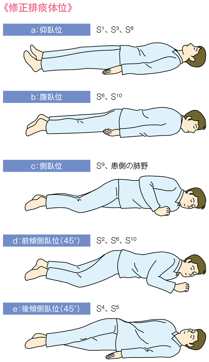 修正排痰体位法