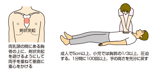 胸骨圧迫説明図