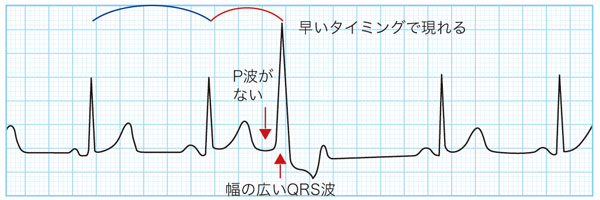心電図でみる心室期外収縮(PVC)の特徴（単発）
