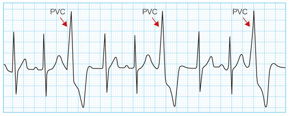 心電図でみる心室期外収縮(PVC)の特徴（頻発）