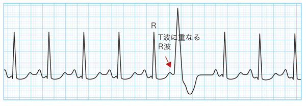 心電図でみる心室期外収縮(PVC)の特徴（RonT型）