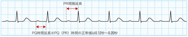 心電図でみる房室ブロック(AVブロック)の特徴（Ｉ度）