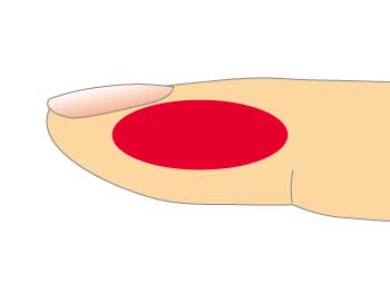 指先の穿刺位置