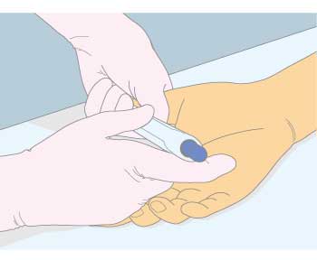 図３固定の仕方