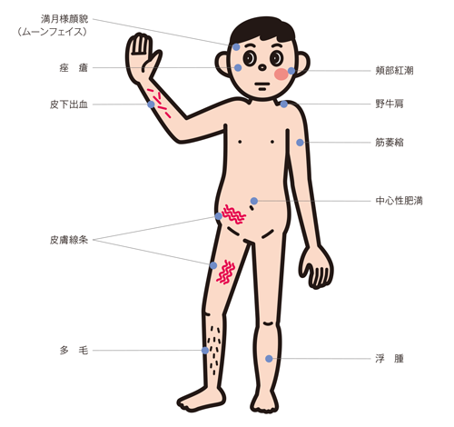 ステロイドによる外見上の変化