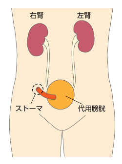 禁制型ストーマ