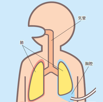 胸腔ドレーンの目的と挿入部位 排出メカニズム ナース専科