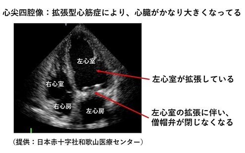 心エコー検査の看護｜目的、種類、検査結果の見方など | ナース専科