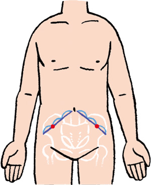 腹水穿刺の穿刺部位