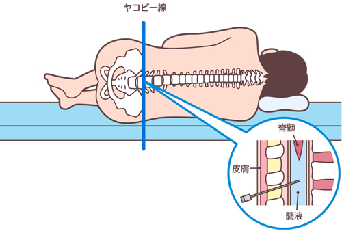 腰椎穿刺 ルンバール の介助 目的 手順 観察項目 合併症とケア ナース専科