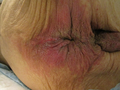 IAD（失禁関連皮膚炎）の写真