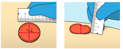 大陸ウロストミー術からの回復