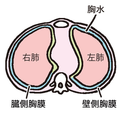 胸膜と胸水の図