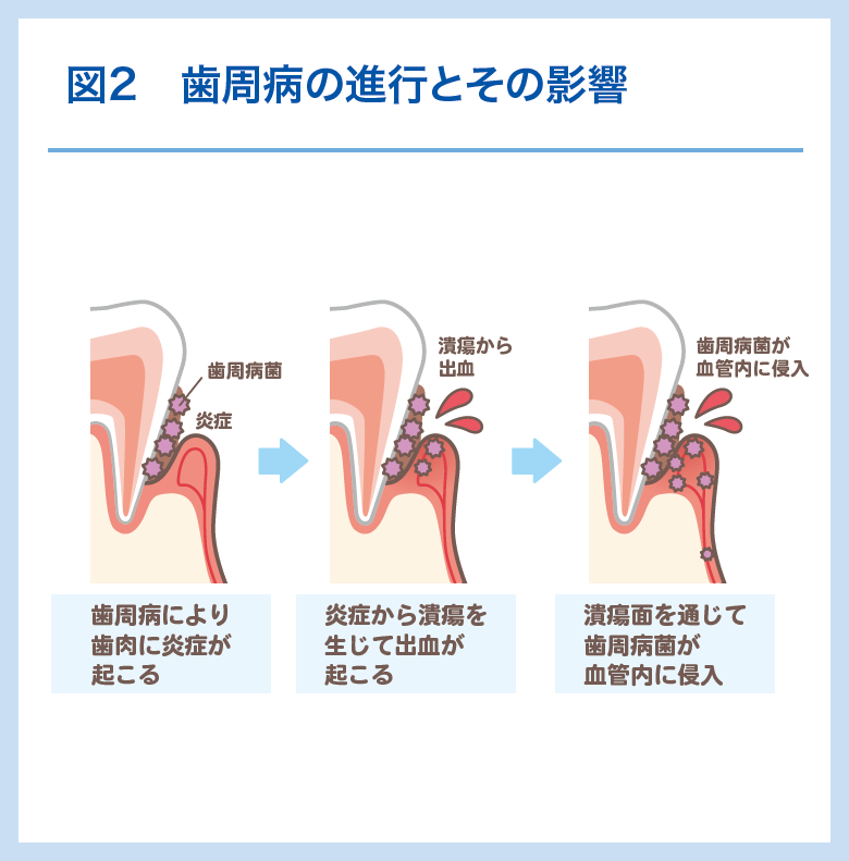 図2 歯周病の進行とその影響