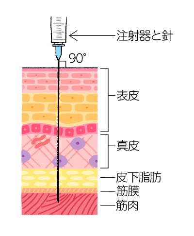 筋肉注射の刺入角度