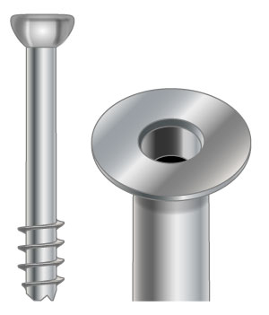 キャニュレイテッドスクリュー