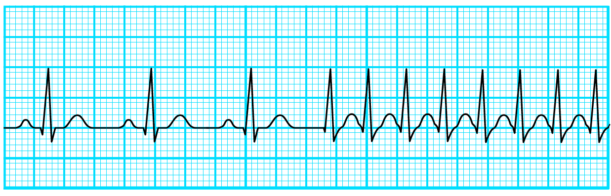 発作性上室性頻拍の波形のイメージ
