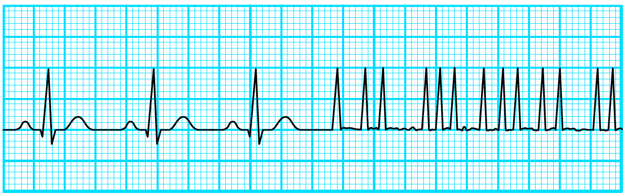 発作性心房細動の波形のイメージ