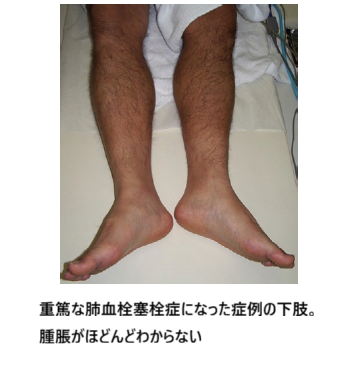 無症候性の深部静脈血栓症