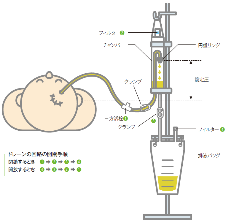 脳室ドレナージシステム