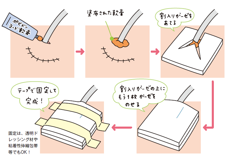 ドレーン刺入部の感染予防