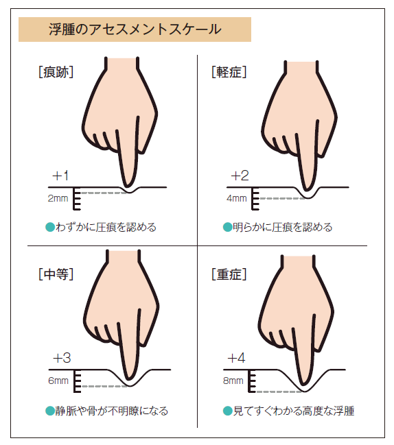 浮腫のアセスメントスケール