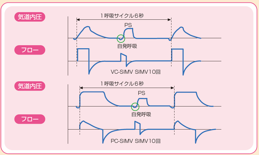 SIMV(+PS)の設定項目