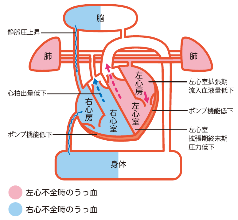 心不全説明図